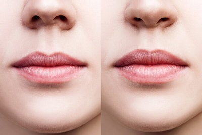 Povećanje usana – hijaluron